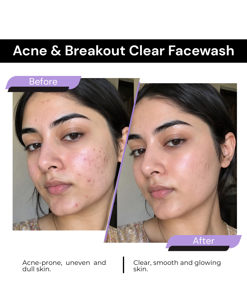 ACNE & BREAKOUT CLEAR FACE WASH