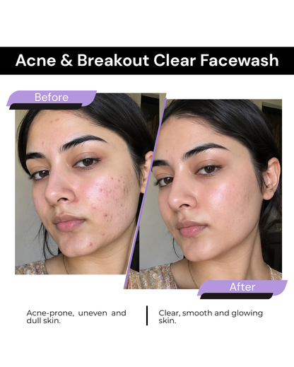 ACNE & BREAKOUT CLEAR FACE WASH