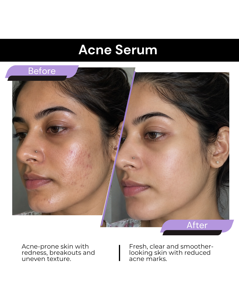 ACNE & BREAKOUT CLEAR SERUM