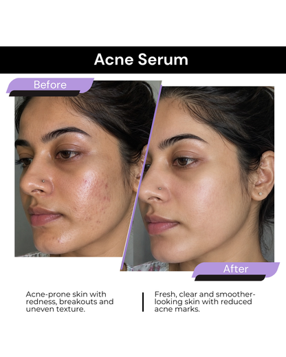 ACNE & BREAKOUT CLEAR SERUM
